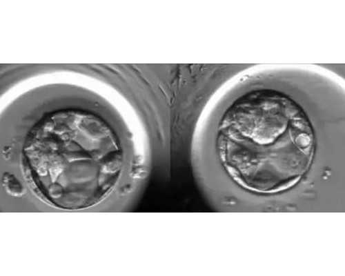 35岁卵巢早衰香港冻卵17颗 供卵助孕性别选择医院